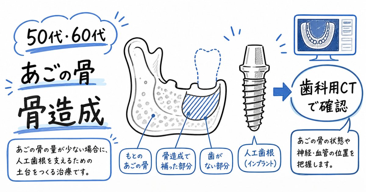 50代・60代で骨が少ない方のインプラント治療｜年齢制限と骨造成