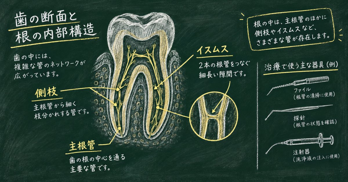 根管治療の側枝・イスムス清掃はなぜ難しいのか歯科医師が解説