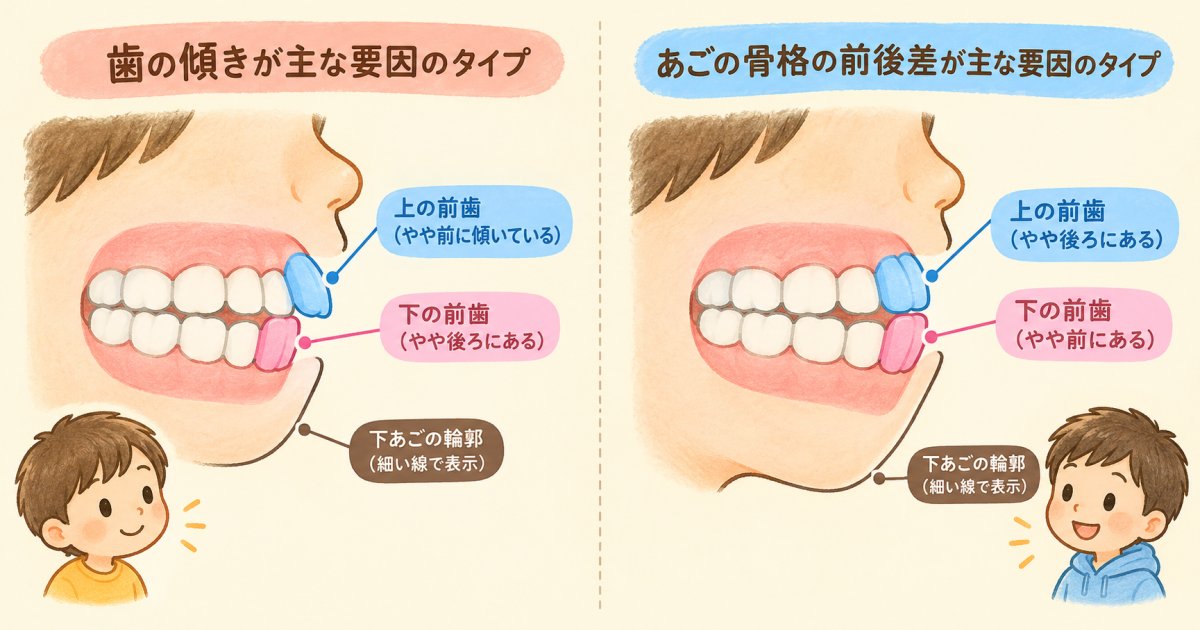 乳歯の受け口、自然に治る子供と治りにくい子供の違い